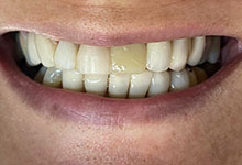Sorriso depois