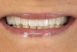 Sorriso antes